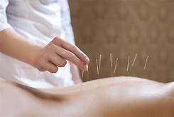How many sessions of acupuncture do you need for back pain?