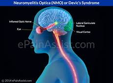 You are currently viewing Neuromyelitis Optica