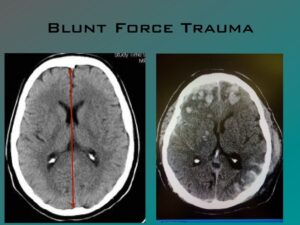 Read more about the article Blunt Trauma to the head